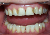 estetinis-dantu-plombavimas