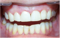 estetinis-dantu-plombavimas