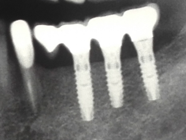 dantų implantai