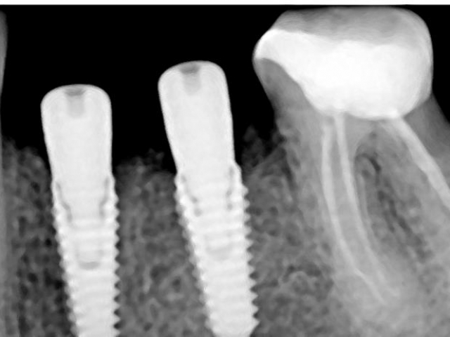 dantų implantavimas