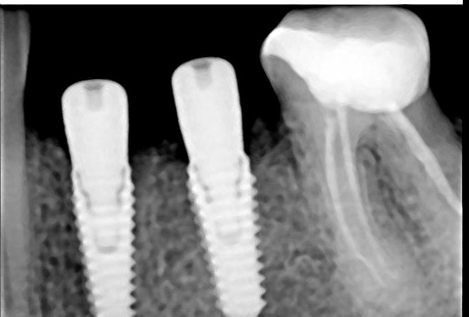 dantų implantavimas