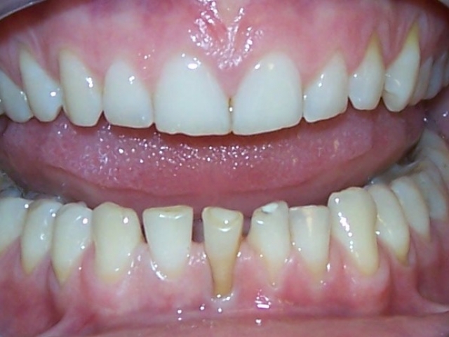 paslankiu-apatiniu-dantu-sutvirtinimas-ir-estetinis-plombavimas-2a