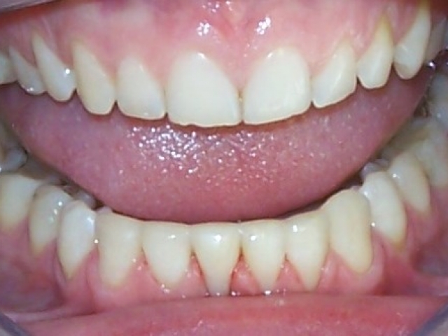 paslankiu-apatiniu-dantu-sutvirtinimas-ir-estetinis-plombavimas-2b