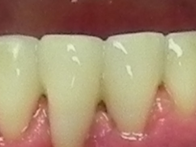 paslankiu-apatiniu-dantu-sutvirtinimas-ir-estetinis-plombavimas-3b